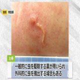 皮下を幼虫がはう「顎口虫症」青森県で初確認　約130人に症状　多くはシラウオ加熱せず食べる  青森県は、寄生虫が皮膚の下に入り込み、傷みや腫れを引き起こす「顎口虫症（がっこうちゅうしょう）」が青森県内で初めて確認された。約130人 多くはシラウオを加熱せず食べていた
