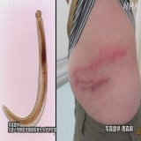 【寄生虫の原因は？】 皮膚の下に寄生虫が入り込み、かゆみや腫れなどを引き起こす「顎口虫（がっこうちゅう）」  青森県で症状を訴える人が確認されました  多くの患者がシラウオを生で食べていたということで、青森県は加熱するよう呼びかけています