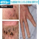 「サル痘」感染者が急増中今年に入り患者55人 厚労省が発疹症状に呼びかけ