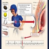 Drs believe Damar Hamlin was likely suffering from commotio cordis where a blow to the chest at a precise moment in the electrical cycle stops the heart. Those trying to tie this to vaccines to project their unscientific beliefs are horrible people. 