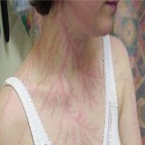 صدق او لا تصدق  "هذه الفتاة تعرضت لصعقة خفيفة من البرق ترك على الجسم أثراً يشبه بأغصان الشجر المتشابكة أو بالخيوط الكهربية المتناغمة في تصميم واحد... #مرصد_الزقورة_الفلكي2 "  قيل أن هذا هو: "التشعب الكهربي البرقي"