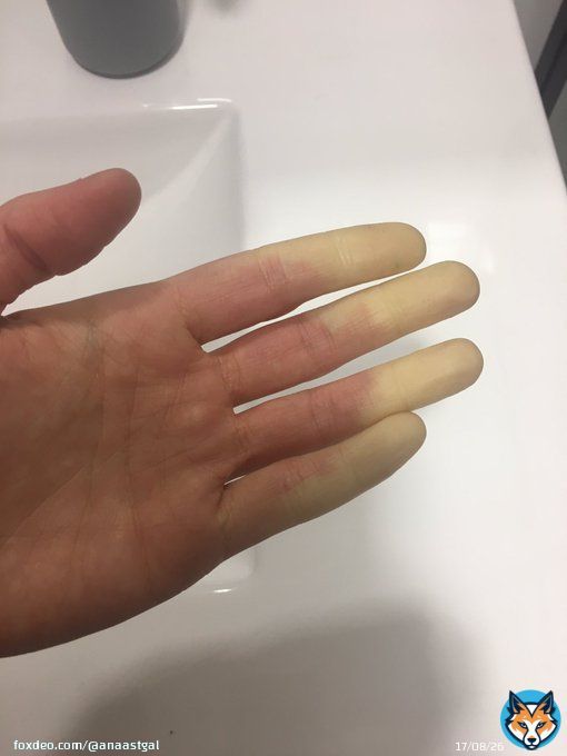 Preg&uacute;ntenle a mi Raynaud si hace fr&iacute;o #enfermedadesraras #lupus #saf