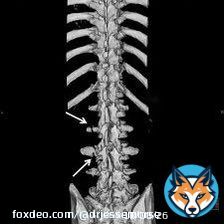 Mike Williams   Transverse Process Fractures   Not uncommon, Stafford & Carr both have had them.   More painful than concerning, take 3-6 weeks to heal. Some players only miss 1-2 weeks.   He&rsquo;s likely done for the playoffs given his positio