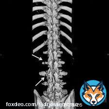 Mike Williams   Transverse Process Fractures   Not uncommon, Stafford & Carr both have had them.   More painful than concerning, take 3-6 weeks to heal. Some players only miss 1-2 weeks.   He&rsquo;s likely done for the playoffs given his positio