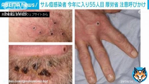 「サル痘」感染者が急増中今年に入り患者55人 厚労省が発疹症状に呼びかけ