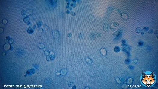 Candida auris, a drug-resistant fungus that health officials hoped to contain is now in more than half the 50 states,