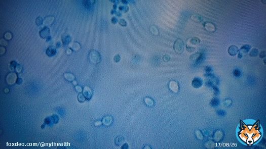 Candida auris, a drug-resistant fungus that health officials hoped to contain is now in more than half the 50 states,
