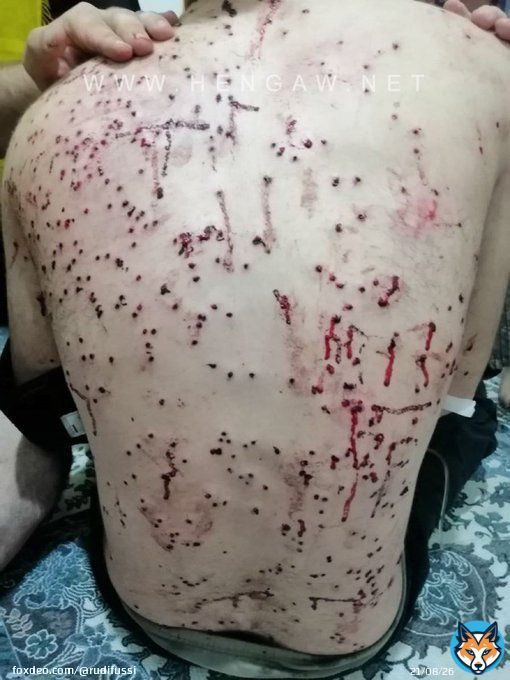 Ein 15 j&auml;hriger aus Mahabad, eine kurdische Stadt im #Iran. Die sog. Sicherheitskr&auml;fte der Islamischen Republik Iran verletzen/ durchl&ouml;chern unter anderem mit Schrotkugeln die Protestierenden, die sich gegen das Regime stellen. Quelle:@HengawO #IranianProtests2022