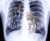 Post-match x-ray of Frances Tiafoe: