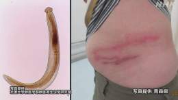 【寄生虫の原因は？】 皮膚の下に寄生虫が入り込み、かゆみや腫れなどを引き起こす「顎口虫（がっこうちゅう）」  青森県で症状を訴える人が確認されました  多くの患者がシラウオを生で食べていたということで、青森県は加熱するよう呼びかけています