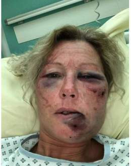 Beziers: Une femme de 50 ans a &eacute;t&eacute; cambriol&eacute;e et rou&eacute;e de coups par ses agresseurs. Elle a &eacute;t&eacute; laiss&eacute;e pour morte. La barbarie et la violence se propage partout en France.. #BFMTV #cnews #GGRMC #hdpros
